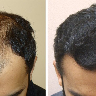 Introducing Aesthetics Hair Restoration