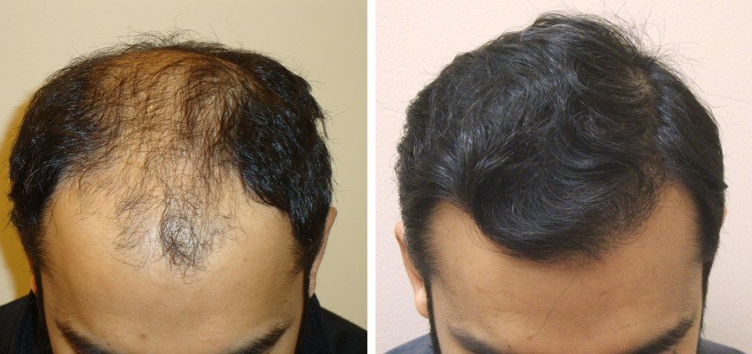 Introducing Aesthetics Hair Restoration